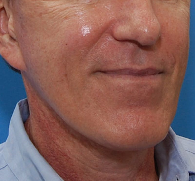 Facelift Before & After Gallery - Patient 136130 - Image 6
