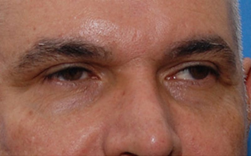 Brow Lift Before & After Gallery - Patient 884744 - Image 4