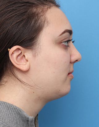 Chin Surgery Before & After Gallery - Patient 121173 - Image 2