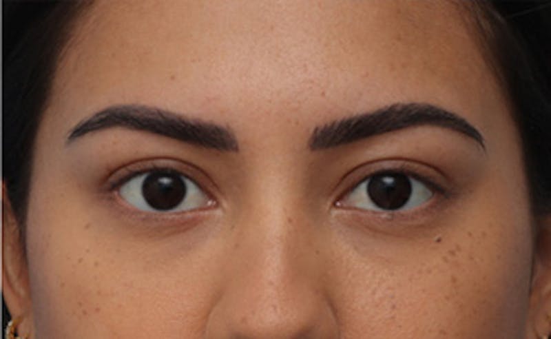Eyelid Surgery Before & After Gallery - Patient 373989 - Image 2