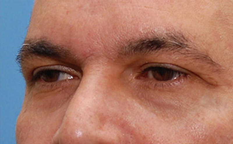 Brow Lift Before & After Gallery - Patient 884744 - Image 5