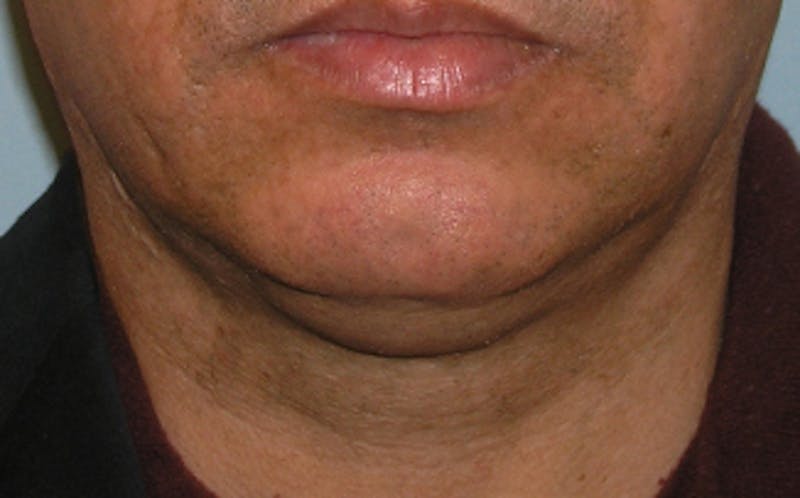 Patient Wfns_QAkRtuQfbfxXiKWfw - Jawline Contouring Before & After Photos