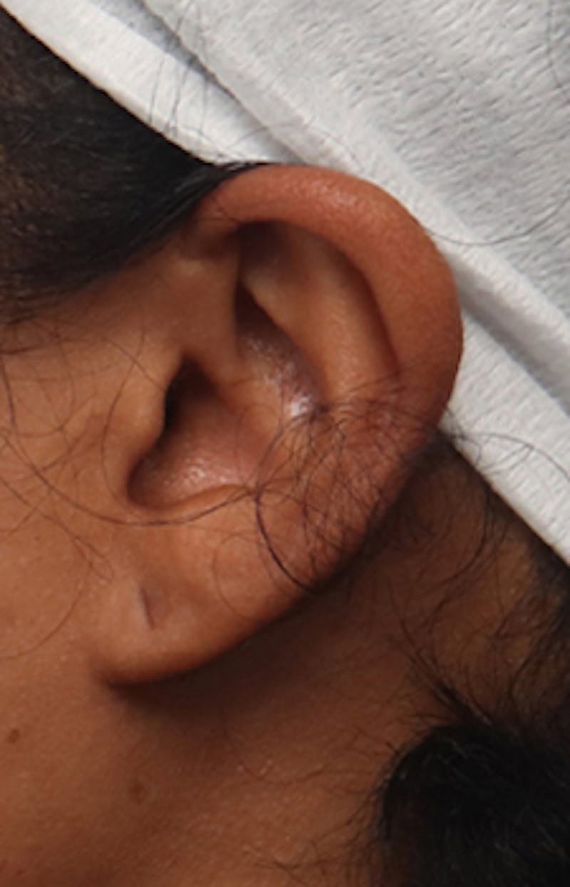 Ear Surgery Before & After Gallery - Patient 265923 - Image 1