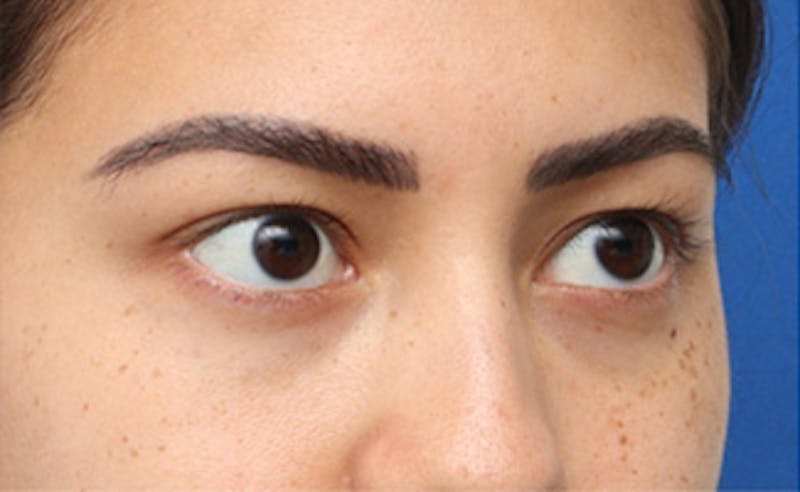 Eyelid Surgery Before & After Gallery - Patient 373989 - Image 3