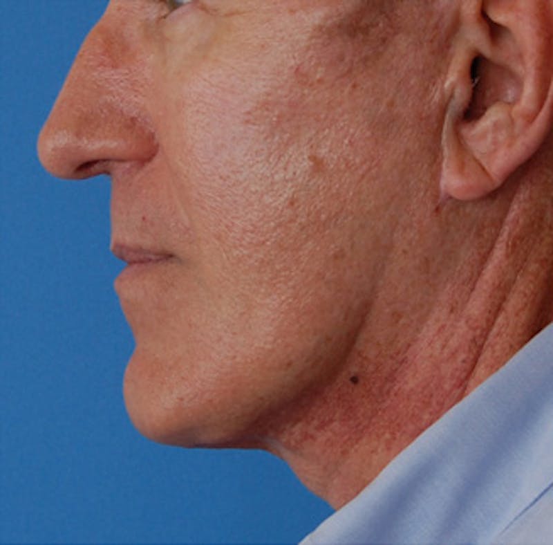 Facelift Before & After Gallery - Patient 136130 - Image 8