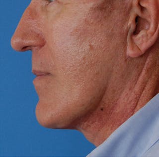Facelift Before & After Gallery - Patient 136130 - Image 8