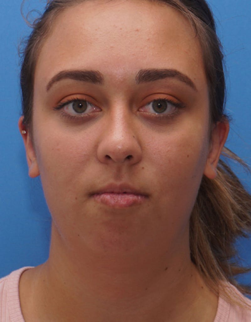 Chin Surgery Before & After Gallery - Patient 121173 - Image 3