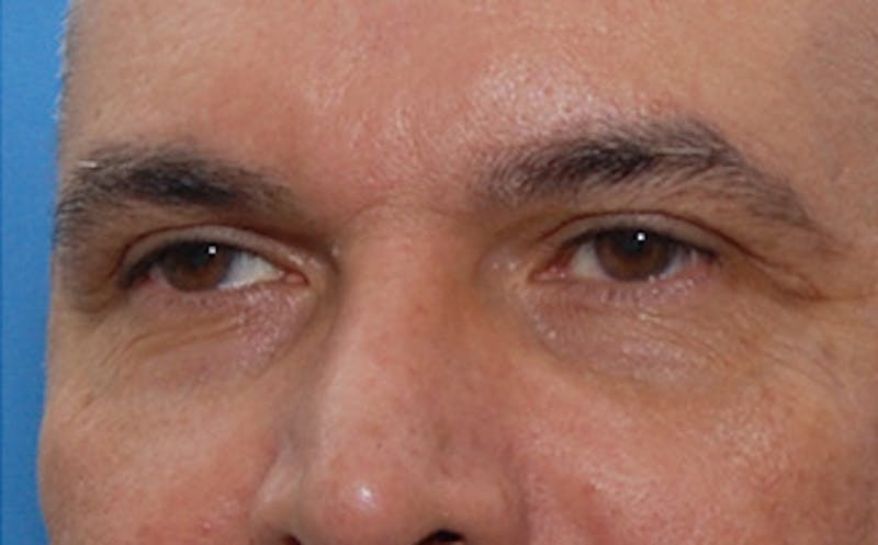 Brow Lift Before & After Gallery - Patient 884744 - Image 6