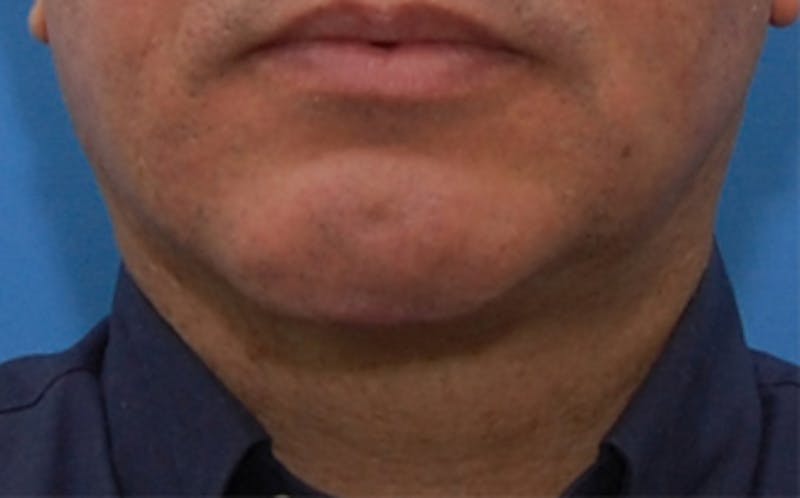 Jawline Contouring Before & After Gallery - Patient 390364 - Image 2