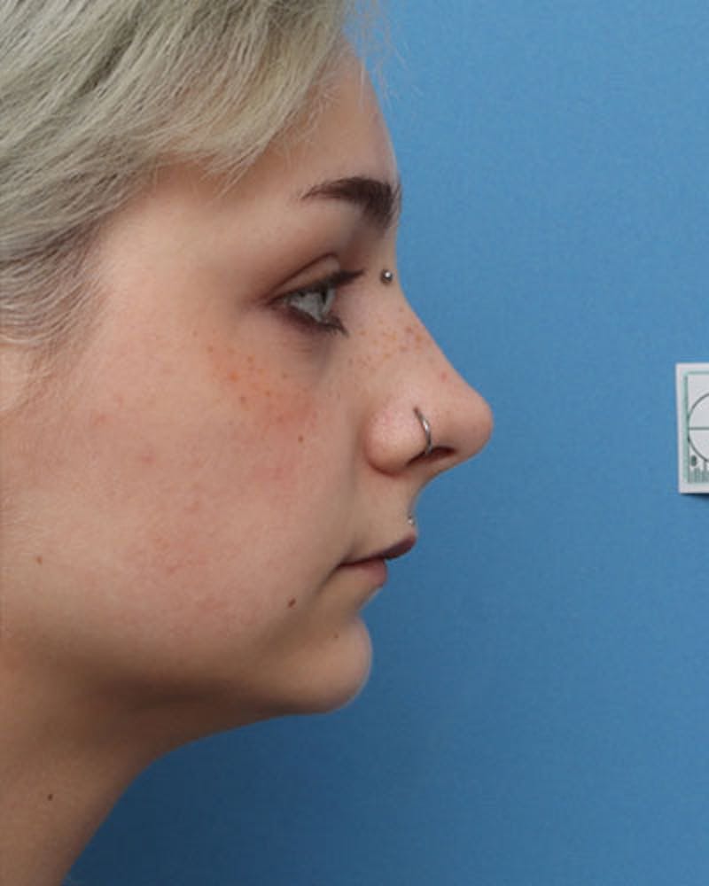 Chin Surgery Before & After Gallery - Patient 842546 - Image 1