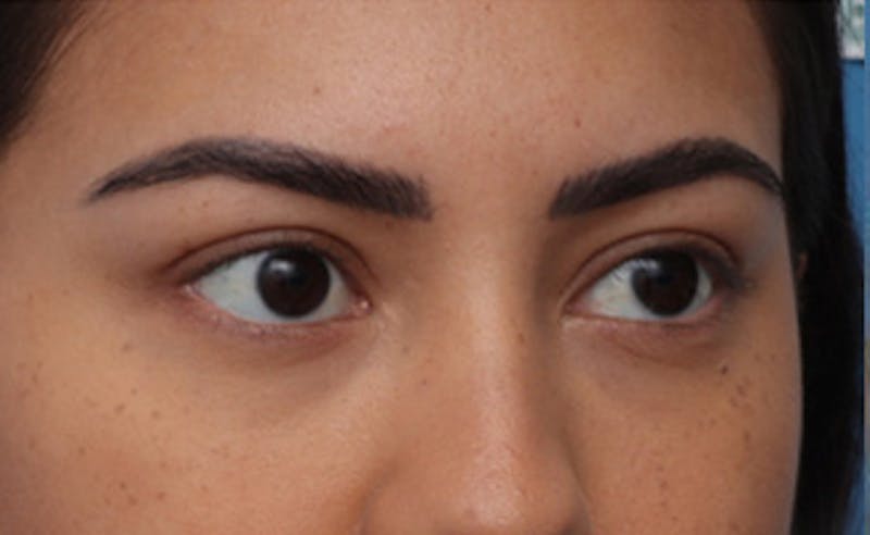 Eyelid Surgery Before & After Gallery - Patient 373989 - Image 4