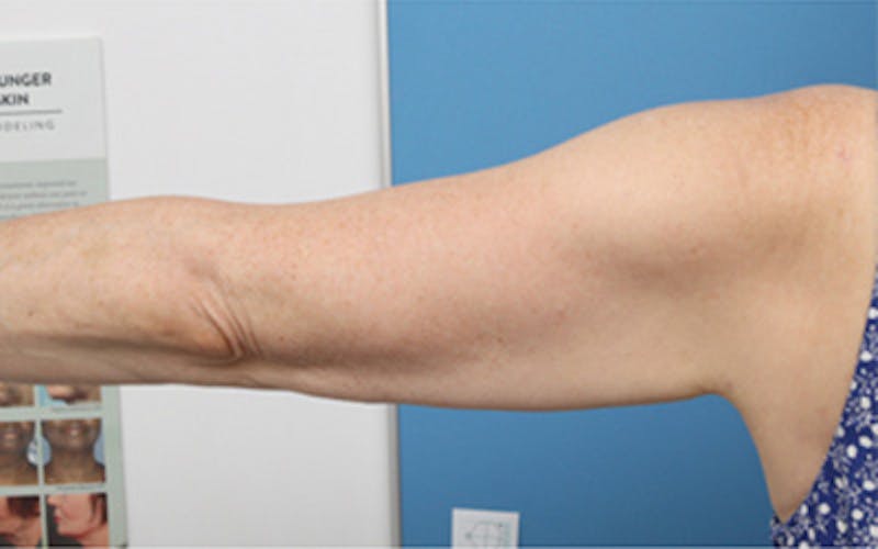 Liposuction (Body) Before & After Gallery - Patient 245990 - Image 6