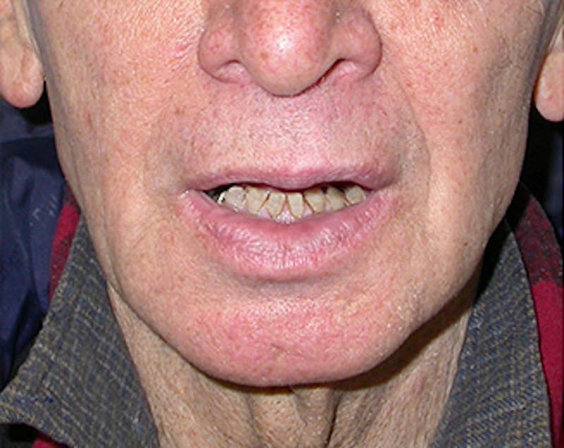 Facelift Before & After Gallery - Patient 618717 - Image 1