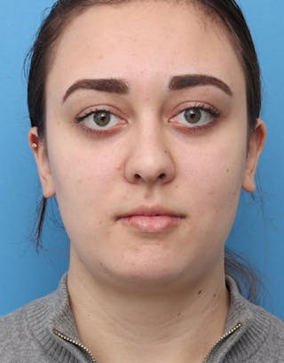 Chin Surgery Before & After Gallery - Patient 121173 - Image 4