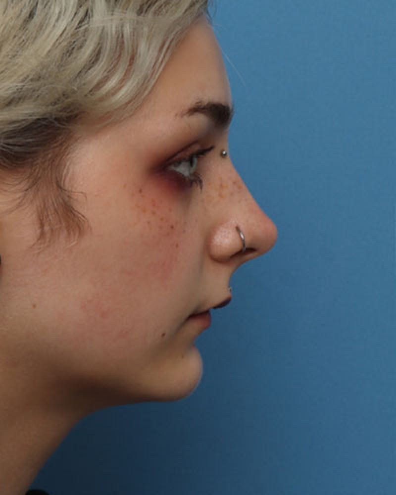 Chin Surgery Before & After Gallery - Patient 842546 - Image 4