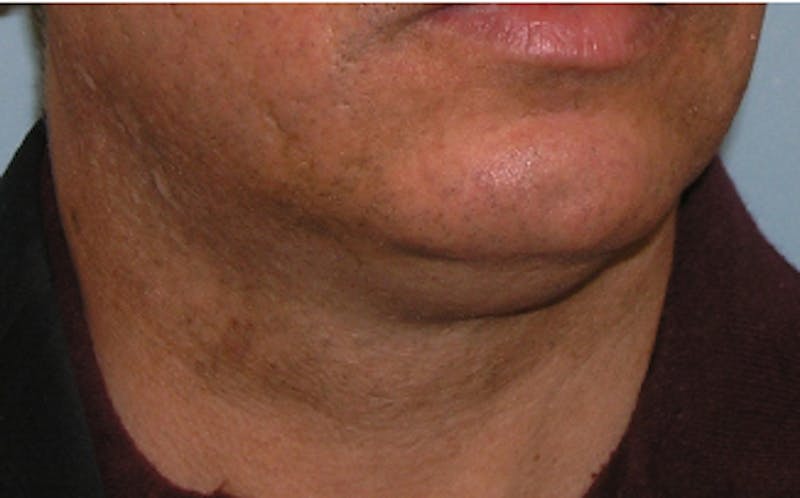 Jawline Contouring Before & After Gallery - Patient 390364 - Image 3