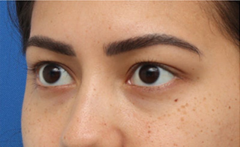 Eyelid Surgery Before & After Gallery - Patient 373989 - Image 5