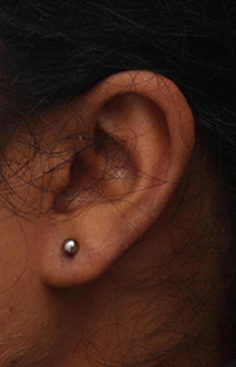 Ear Surgery Before & After Gallery - Patient 265923 - Image 3