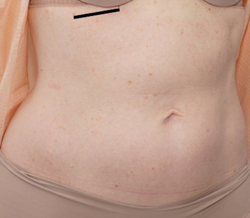 Liposuction (Body) Before & After Gallery - Patient 352394 - Image 1