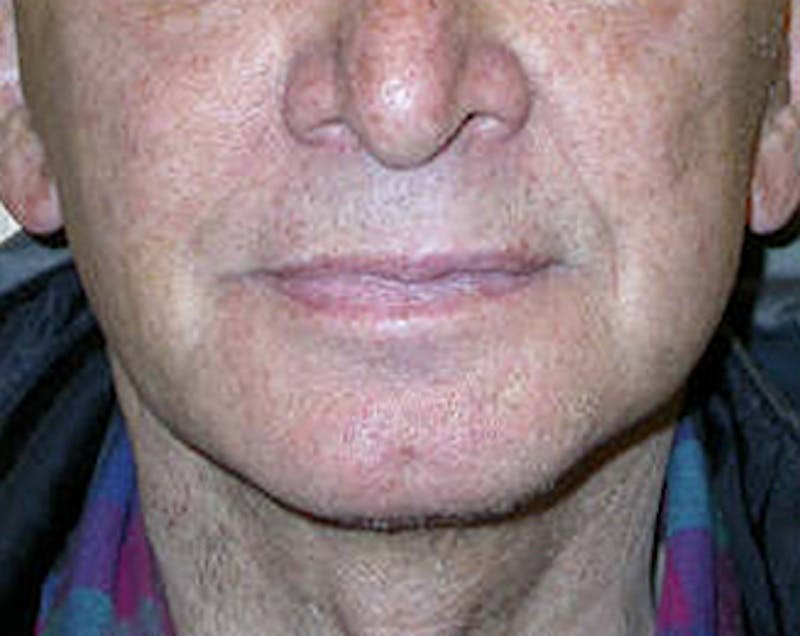 Facelift Before & After Gallery - Patient 618717 - Image 2