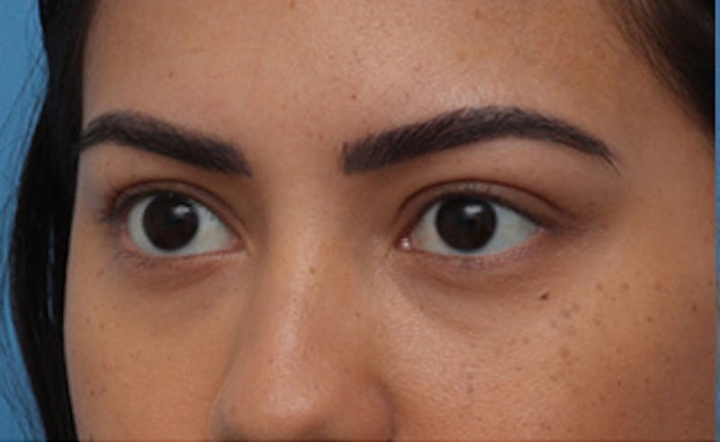 Eyelid Surgery Before & After Gallery - Patient 373989 - Image 6