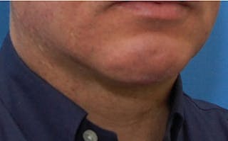 Jawline Contouring Before & After Gallery - Patient 390364 - Image 4