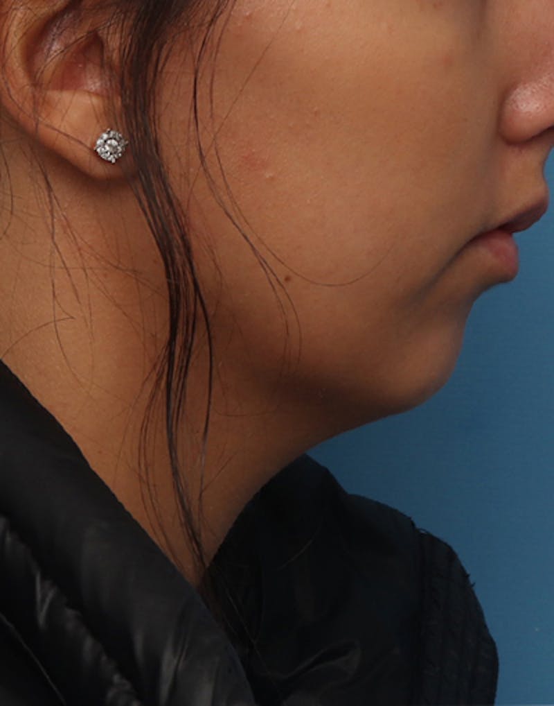 Patient b-DFqrbCS1ifV0ULEmHzzQ - Neck Liposuction Before & After Photos