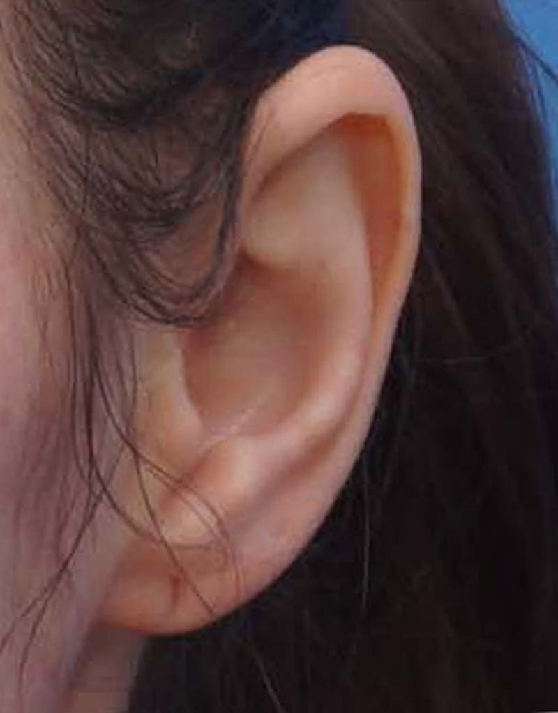 Patient a11JPnlyRl-14-kXPUu1Eg - Earlobe Surgery Before & After Photos