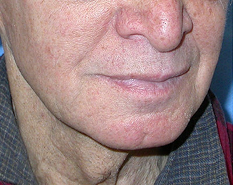 Facelift Before & After Gallery - Patient 618717 - Image 3