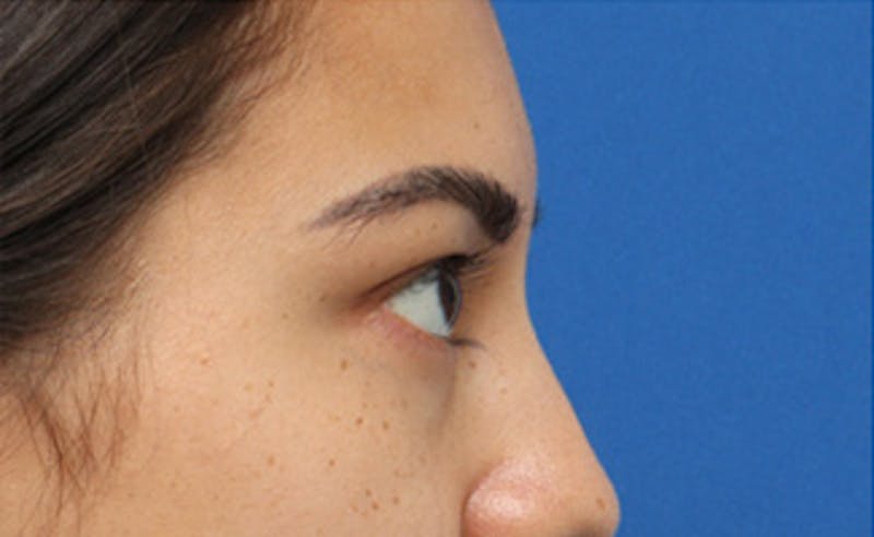 Eyelid Surgery Before & After Gallery - Patient 373989 - Image 7