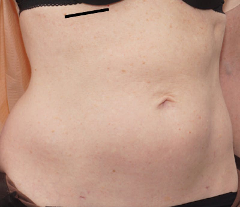 Liposuction (Body) Before & After Gallery - Patient 352394 - Image 2