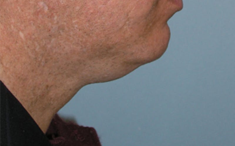 Jawline Contouring Before & After Gallery - Patient 390364 - Image 5
