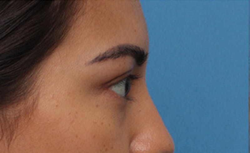 Eyelid Surgery Before & After Gallery - Patient 373989 - Image 8