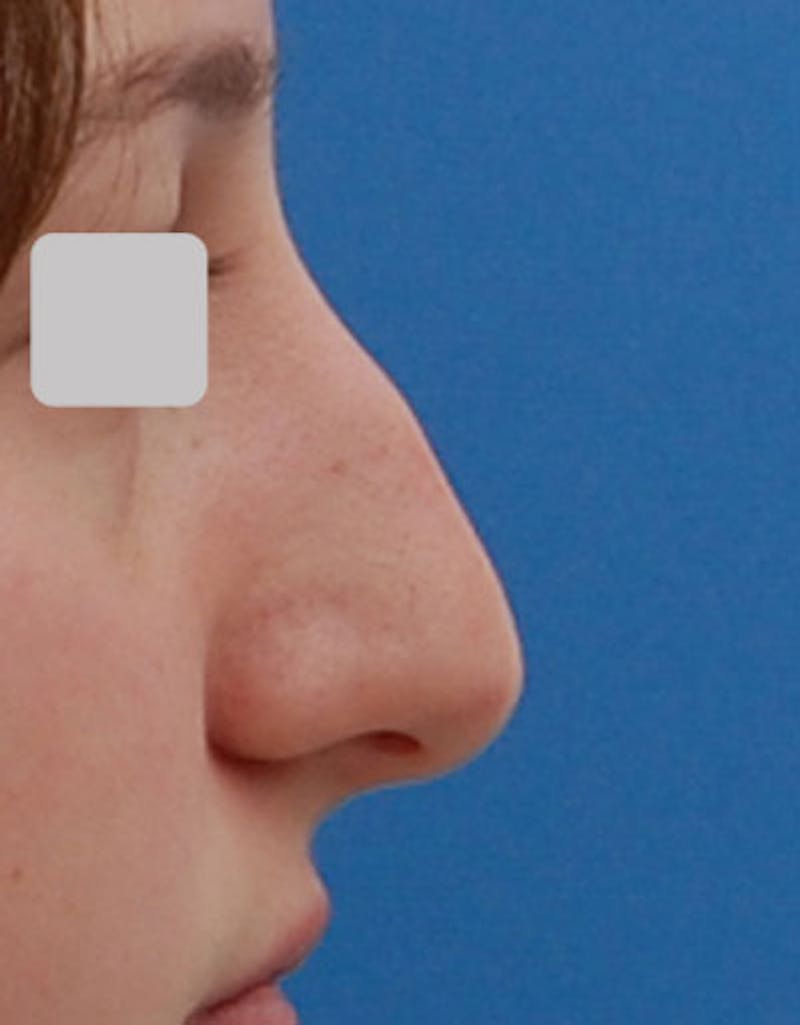 Rhinoplasty Before & After Gallery - Patient 282134 - Image 1