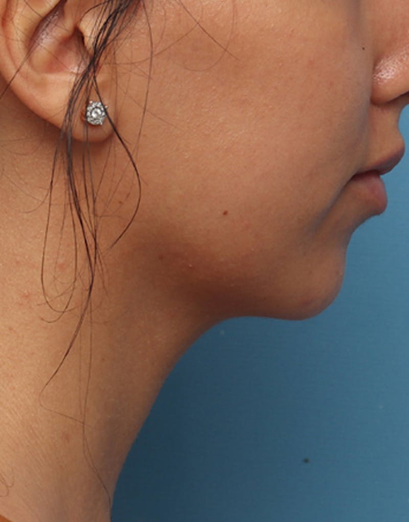 Neck Liposuction Before & After Gallery - Patient 382631 - Image 2