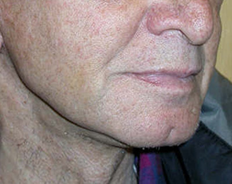 Facelift Before & After Gallery - Patient 618717 - Image 4