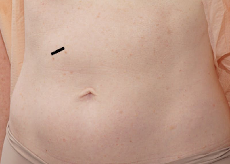 Liposuction (Body) Before & After Gallery - Patient 352394 - Image 3
