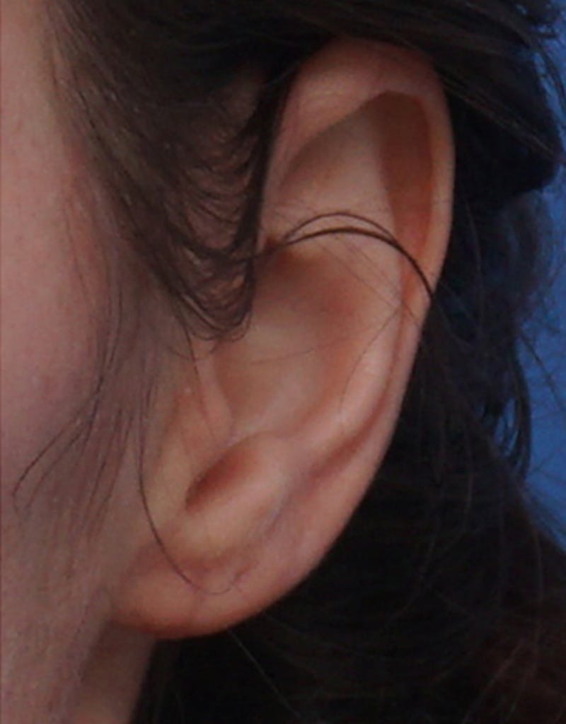 Ear Surgery Before & After Gallery - Patient 811749 - Image 2