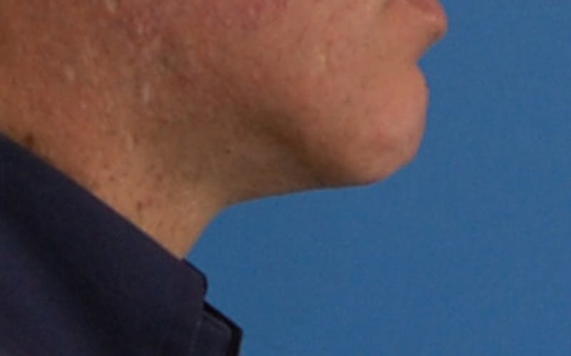 Jawline Contouring Before & After Gallery - Patient 390364 - Image 6
