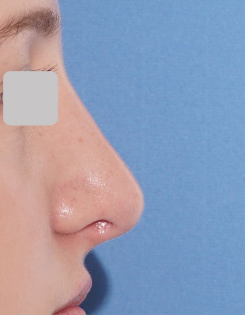 Rhinoplasty Before & After Gallery - Patient 282134 - Image 2