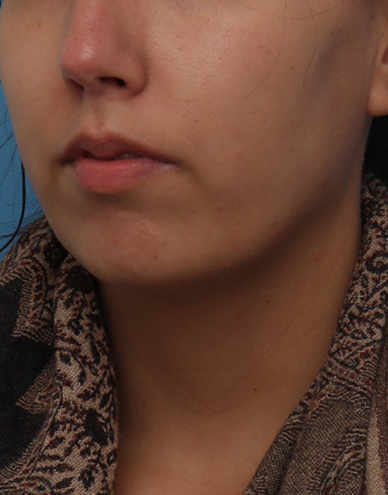 Chin Surgery Before & After Gallery - Patient 368478 - Image 3