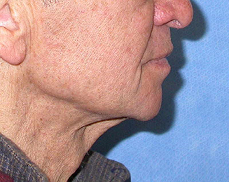 Facelift Before & After Gallery - Patient 618717 - Image 5