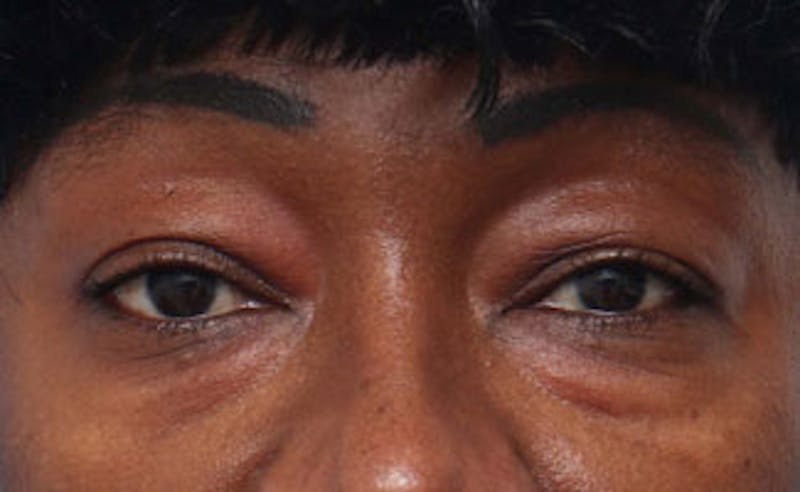Patient KDJOq1OBTkyi_J-nmkem-Q - Eyelid Surgery Before & After Photos