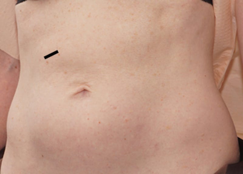 Liposuction (Body) Before & After Gallery - Patient 352394 - Image 4