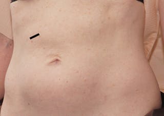 Liposuction (Body) Before & After Gallery - Patient 352394 - Image 4