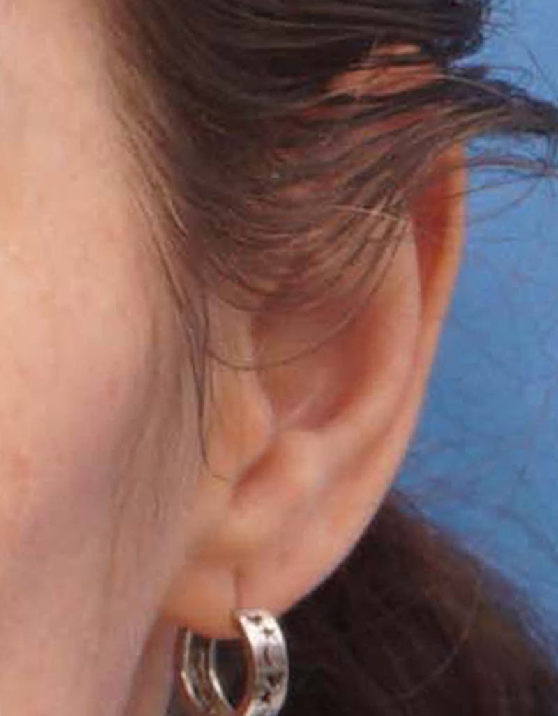 Ear Surgery Before & After Gallery - Patient 811749 - Image 3