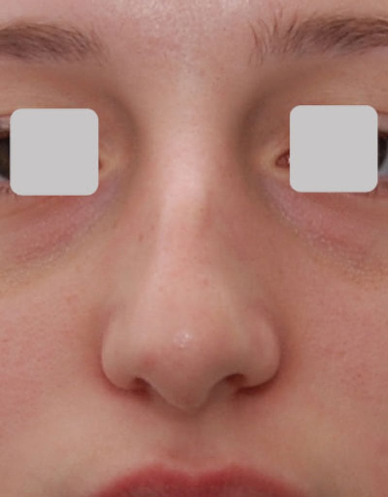 Rhinoplasty Before & After Gallery - Patient 282134 - Image 3
