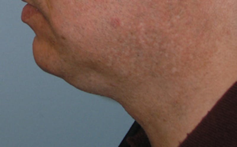 Jawline Contouring Before & After Gallery - Patient 390364 - Image 7