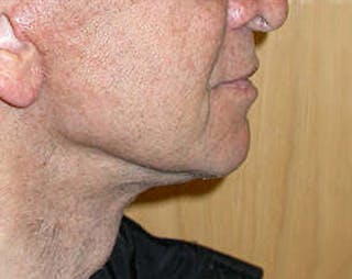 Facelift Before & After Gallery - Patient 618717 - Image 6