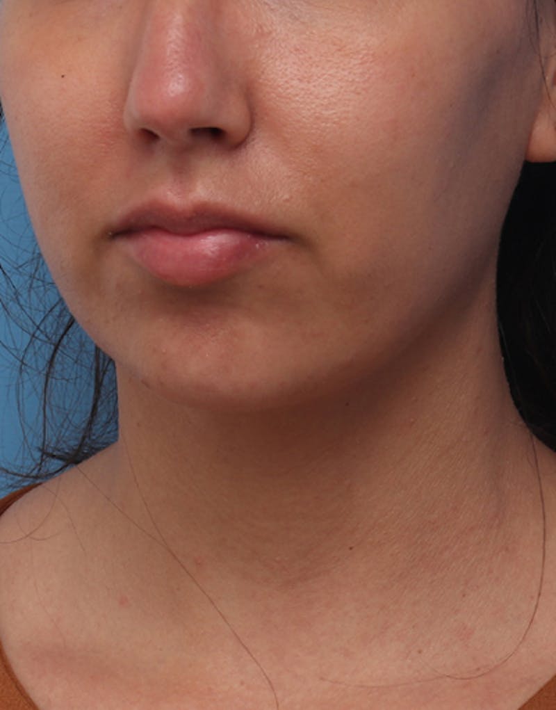 Neck Liposuction Before & After Gallery - Patient 382631 - Image 4